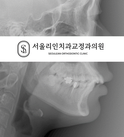 골격성 2급 부정교합 상악 편악발치 엑스레이 전후 비교